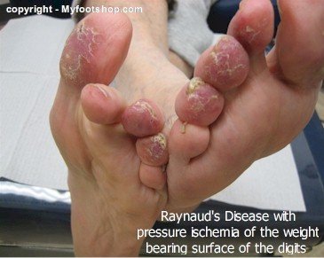Raynaud's disease